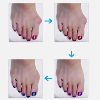 Orthopedic Bunion Corrector - A Non-Surgical Treatment - Image 9