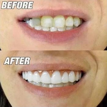 Premium Quality Perfect Smile Veneers - Image 3