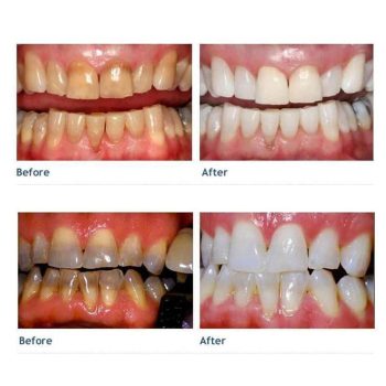 Pro Nano Teeth Whitening Kit - Image 5