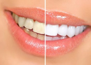 Teeth Whitening Pen White Tooth Cleaning Bleaching - Image 3